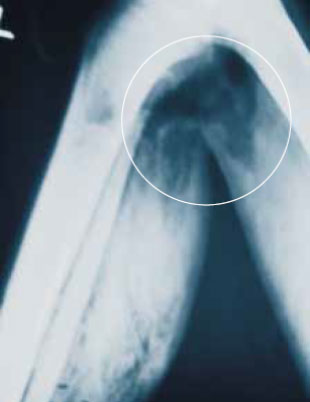 Воздух в тканях Воздух в тканях