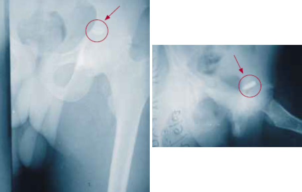 Пуля в тазобедренном суставе Пуля в тазобедренном суставе