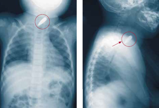 Пуля в верхнем средостении Пуля в верхнем средостении
