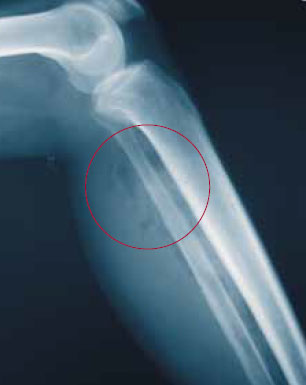 Газовая гангрена Газовая гангрена