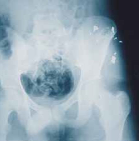 Разрушившаяся пуля в забрюшинном мышечном массиве Разрушившаяся пуля в забрюшинном мышечном массиве