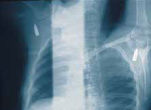 Пуля в подмышечной ямке Пуля в подмышечной ямке