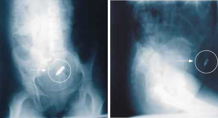 Пуля в матке с доношенным плодом Пуля в матке с доношенным плодом