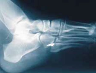 Металлический осколок находится в подошве ступни Металлический осколок находится в подошве ступни