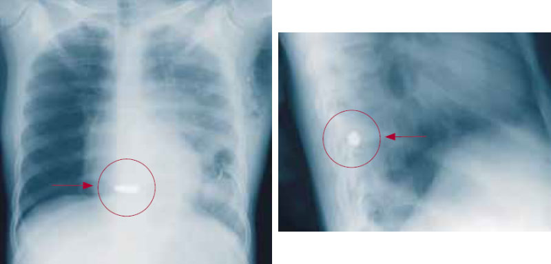 Пуля в позвоночнике Пуля в позвоночнике