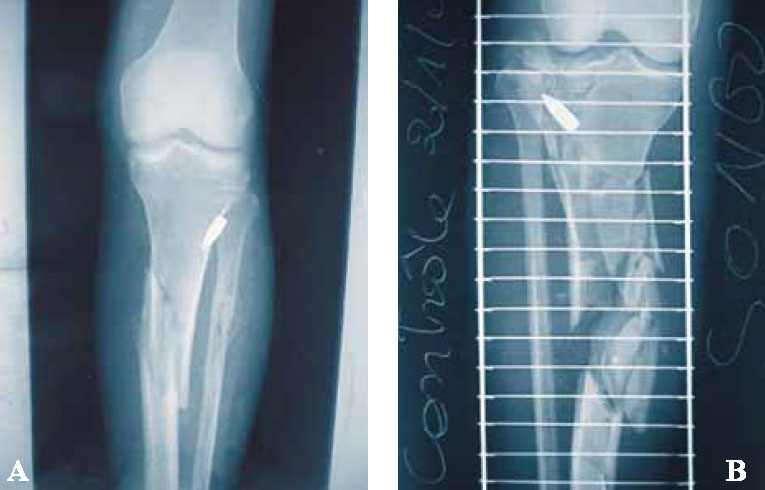 Пуля в голени Пуля в голени