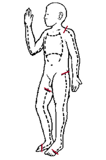 Места нанесения разрезов по ожоговому струпу Места нанесения разрезов по ожоговому струпу