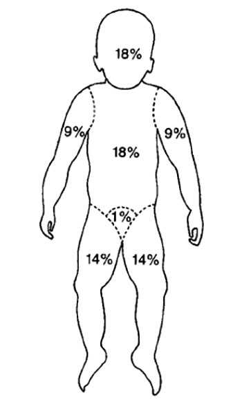 Принцип определения площади ожога у детей Принцип определения площади ожога у детей