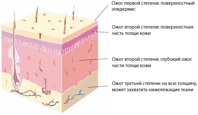 Степени глубины ожога Степени глубины ожога