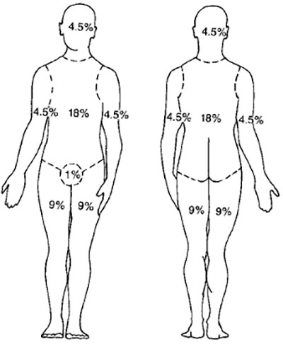 Принцип определения площади ожога у взрослых Принцип определения площади ожога у взрослых
