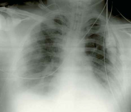 Двусторонний легочный инфильтрат Двусторонний легочный инфильтрат