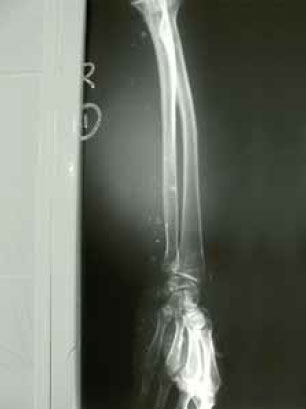 Осколки стекла в тканях Осколки стекла в тканях