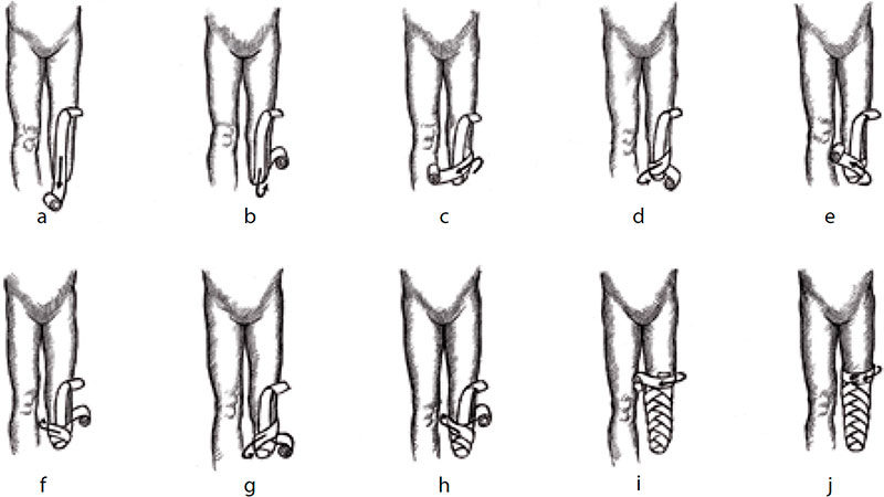 Восьмиобразные эластичные повязки на ампутационных культях Восьмиобразные эластичные повязки на ампутационных культях