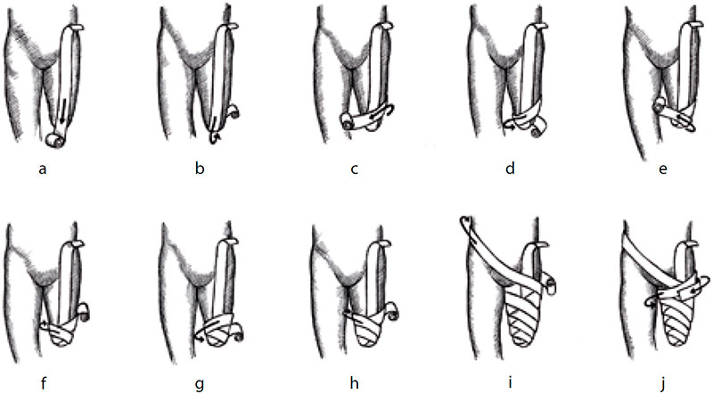 Восьмиобразные эластичные повязки на ампутационных культях Восьмиобразные эластичные повязки на ампутационных культях