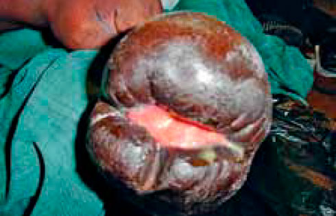 Раневая инфекция Раневая инфекция