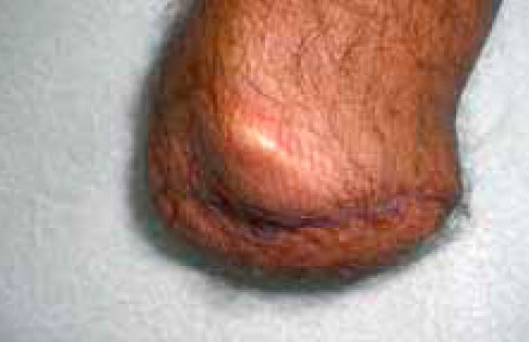 Неудаленная передняя часть гребня большеберцовой кости Неудаленная передняя часть гребня большеберцовой кости