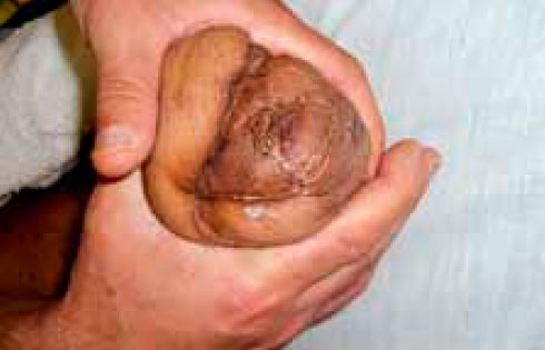 Слипшийся рубец Слипшийся рубец