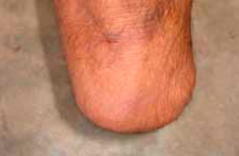 Очень короткая культя Очень короткая культя