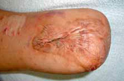 Выпячивание рубца Выпячивание рубца