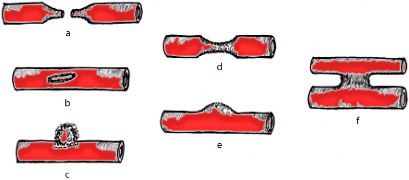 Типы повреждений артерий Типы повреждений артерий