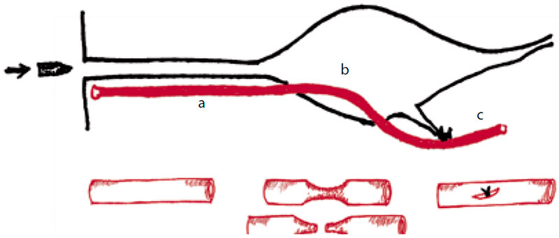 Артерия вблизи раневого канала Артерия вблизи раневого канала
