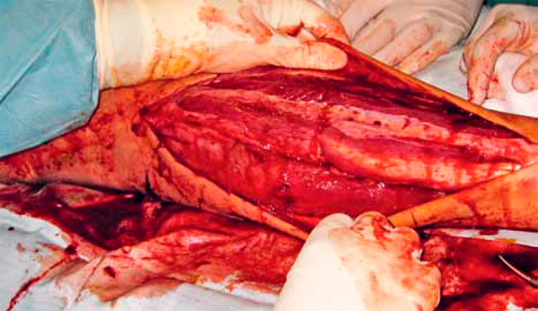 Длинный разрез для обнажения сосудов Длинный разрез для обнажения сосудов