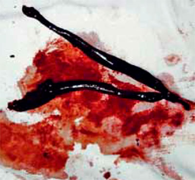 Тромб Тромб