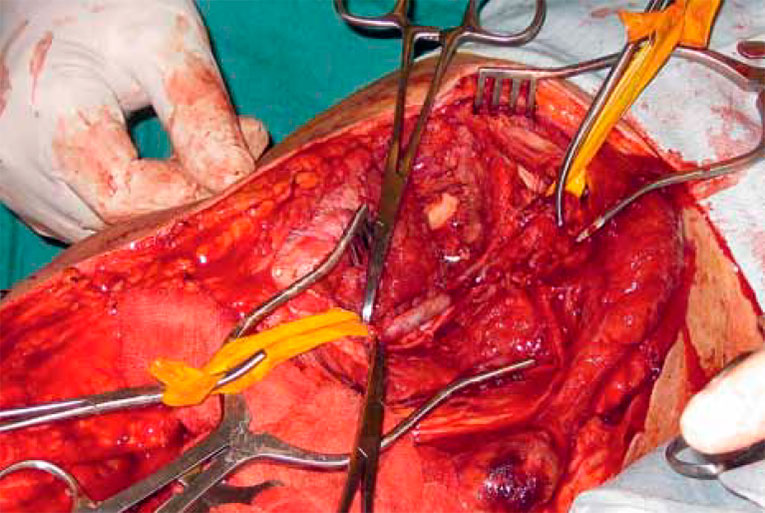 Проксимальное и дистальное пережатие сосуда Проксимальное и дистальное пережатие сосуда