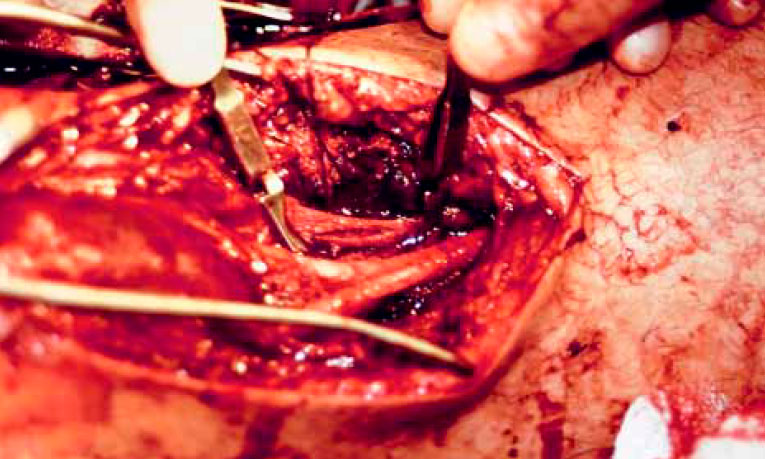 Латеральный разрыв артерии Латеральный разрыв артерии