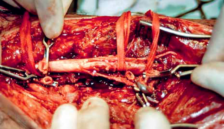 Перерезанные концы сосуда Перерезанные концы сосуда