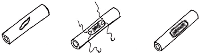 Закрытие латерального разрыва артерии Закрытие латерального разрыва артерии