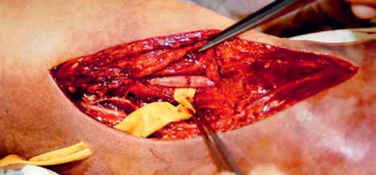 Прямой анастомоз артерии Прямой анастомоз артерии