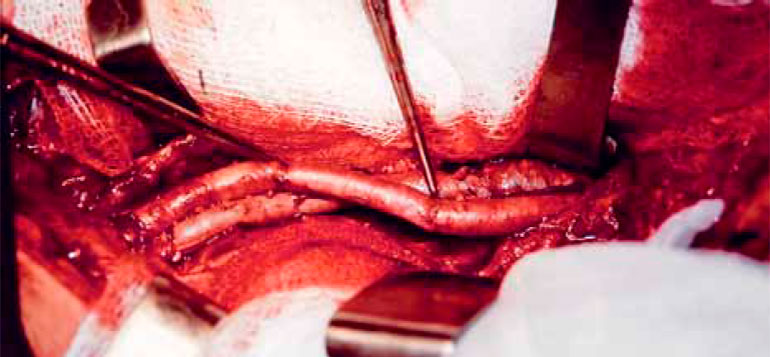 Интерпозиционная пластика венозным трансплантатом Интерпозиционная пластика венозным трансплантатом